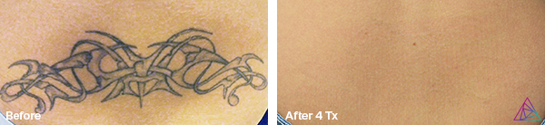Before and after tattoo removal
